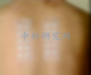 斑貼測試